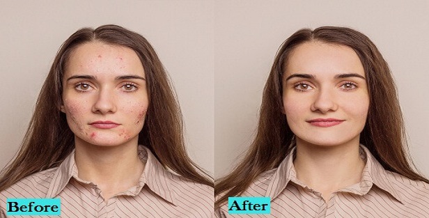 best-acne-scars-treatment-in-pune