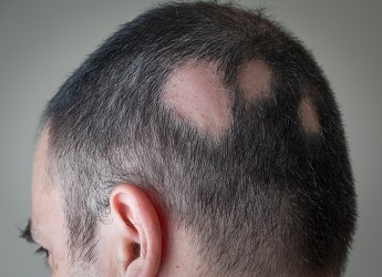 best-alopecia-areata-treatment-in-pune