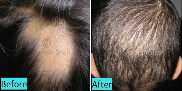 alopecia-areata-cure-in-pune