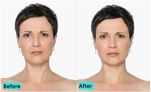 best-botox-and-fillers-treatment-in-pune