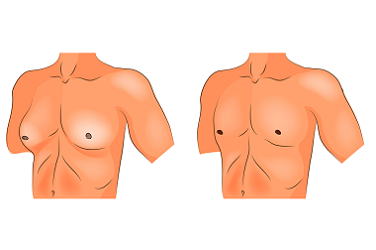 best-breast-reduction-surgery-in-pune