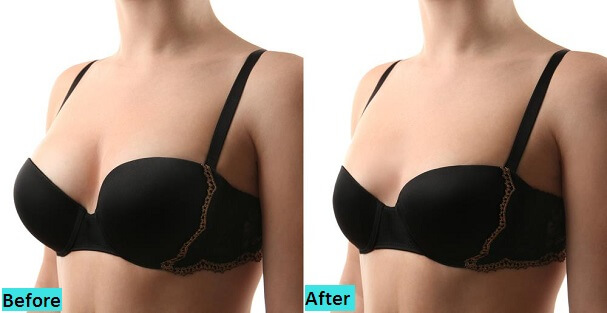 best-breast-reduction-surgery-in-pune