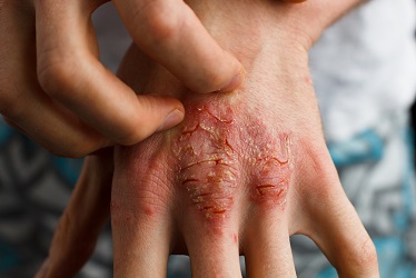 Psoriasis-skin-Treatment-in-pune