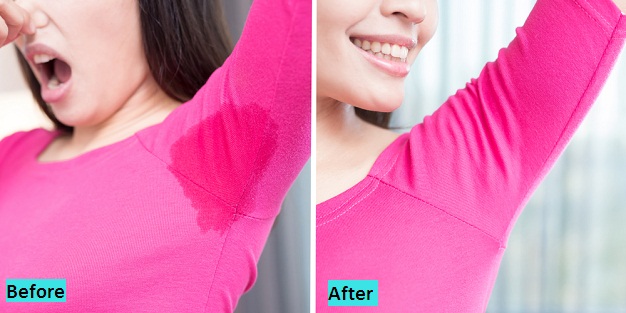 best-excessive-sweating-treatment-in-pune