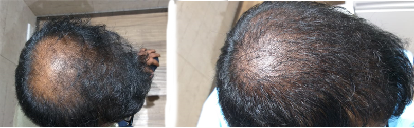 best-scalp-micropigmentation-treatment-in-pune