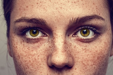 best-freckles-sunspots-treatment-in-pune