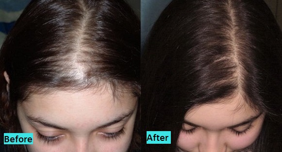 hair restoration treatment in pune
