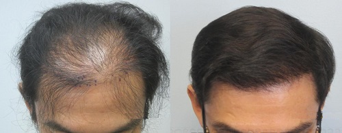best-fue-hair-transplant-results-at-skin-world-pune-india