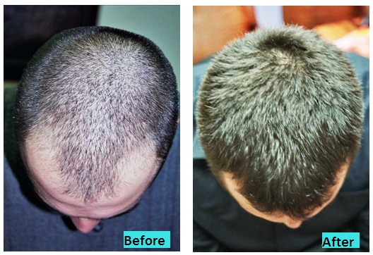 best-laser-hairgrow-therapy-in-pune-india