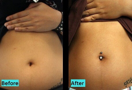 best-medically-supervised-piercing-in-pune