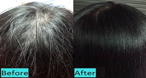 premature-graying-treatment-in-pune-india