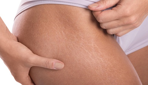 best-stretch-marks-treatment-in-pune