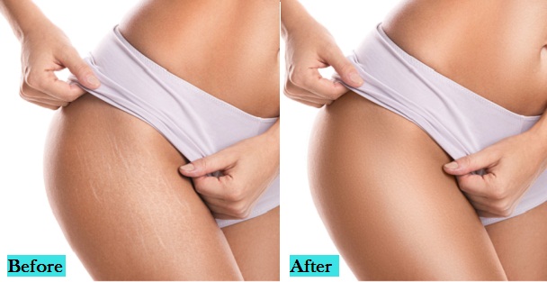 best-stretch-marks-treatment-in-pune