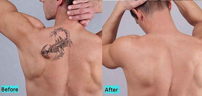 tattoo-removal-in-pune