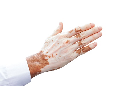 best-vitiligo-surgery-clinic-in-pune-india