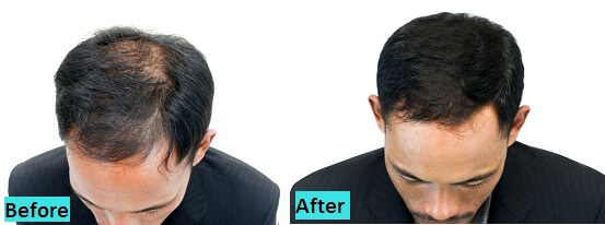 best-hairfall-cure-results-in-pune