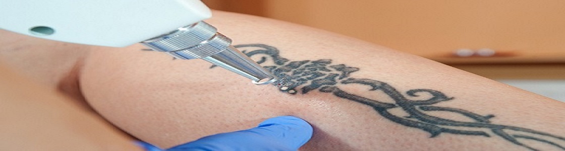 Treatment of a tattoo with a longpulsed hair removal laser resulted in   Download Scientific Diagram